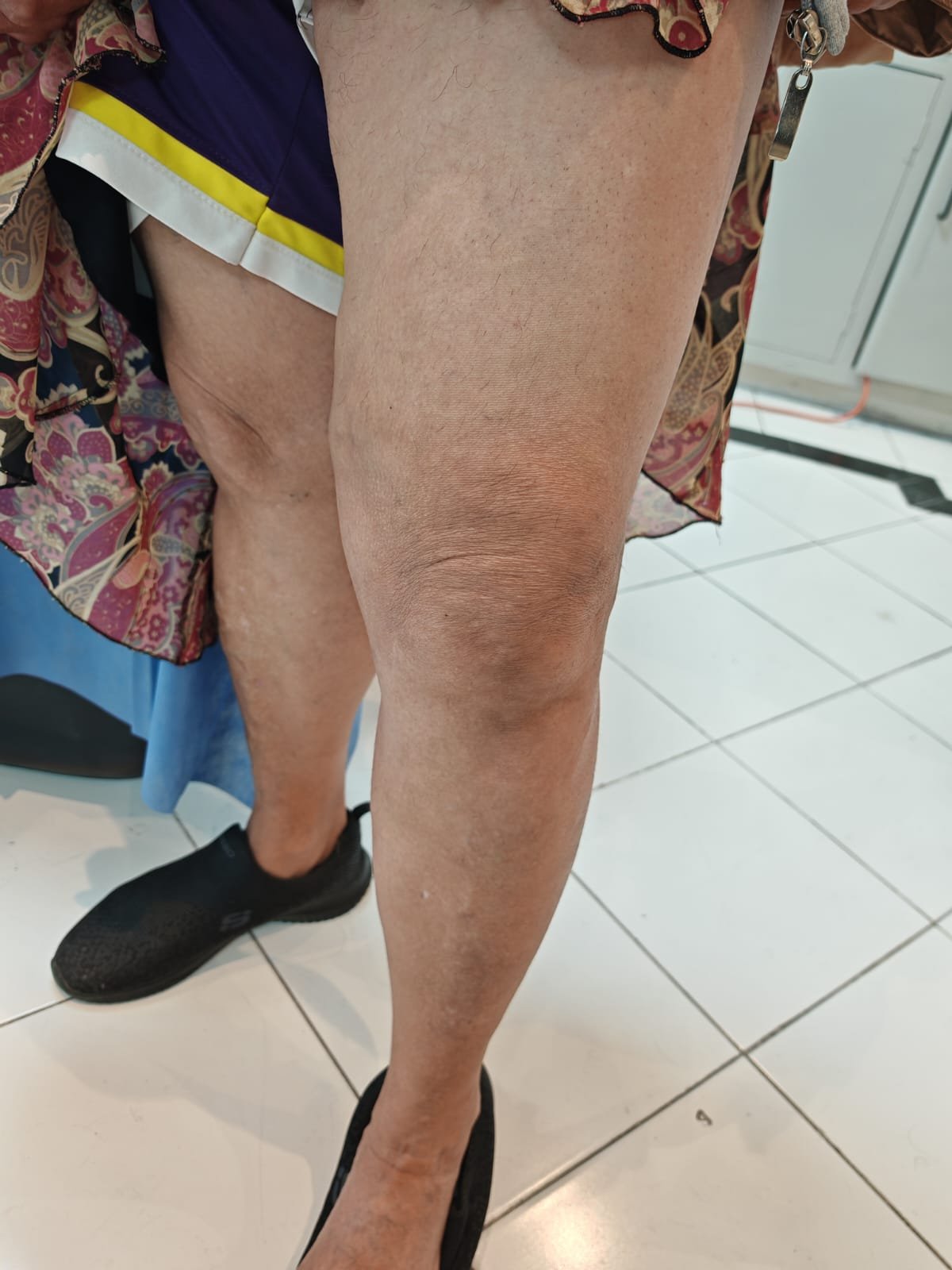 Caso 2 después del tratamiento