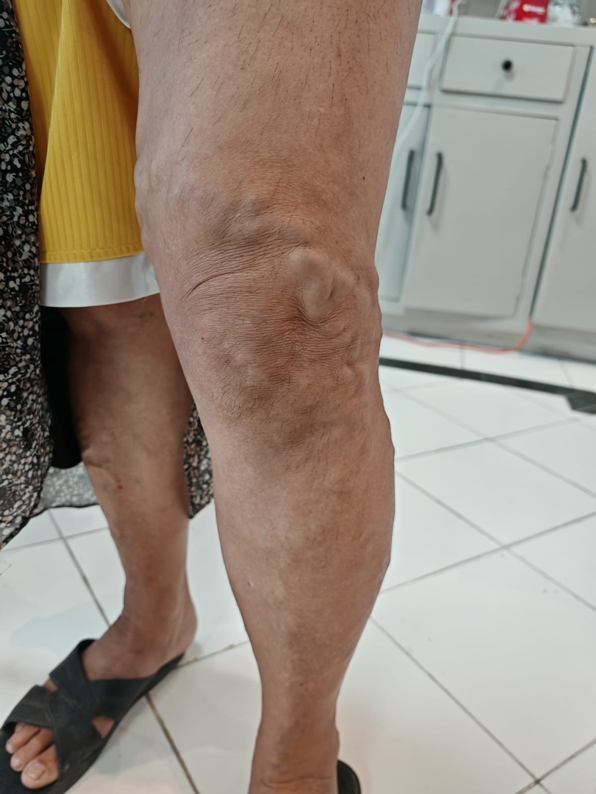 Caso 2 antes del tratamiento