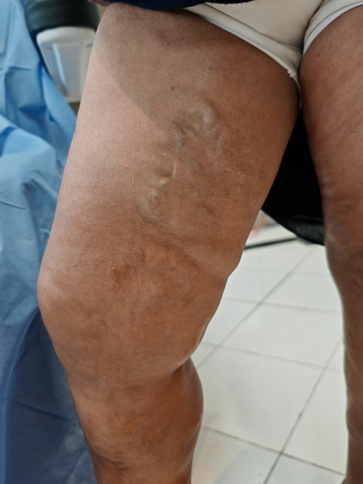 Caso 3 antes del tratamiento